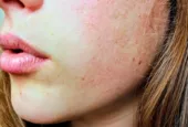Pourquoi mes pores paraissent-ils plus visibles après certains soins naturels ?