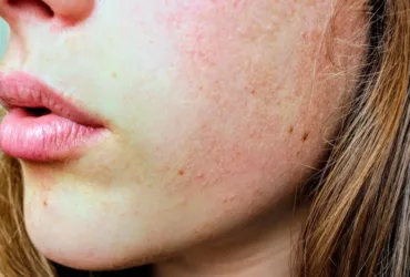 Pourquoi mes pores paraissent-ils plus visibles après certains soins naturels ?