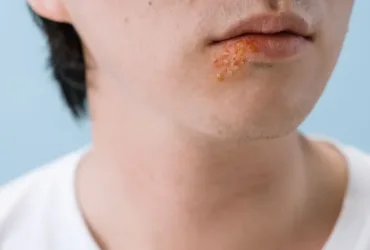 Soigner ampoule pied remède grand-mère : quelles astuces sont les plus efficaces ?