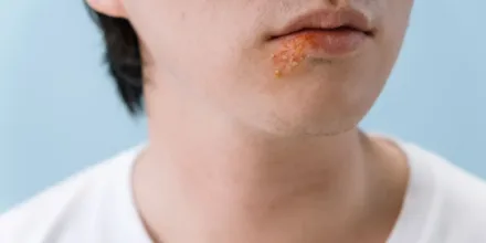 Soigner ampoule pied remède grand-mère : quelles astuces sont les plus efficaces ?